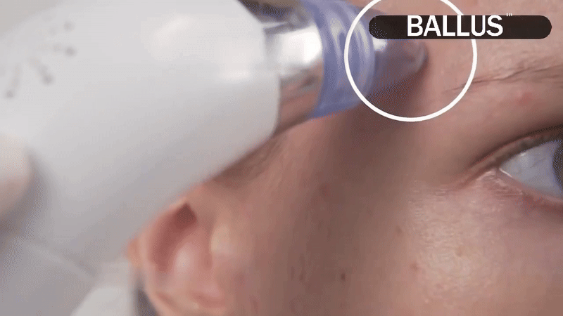 Pore Cleansing Device for Face – Blackhead Vacuum & Skin Purifier